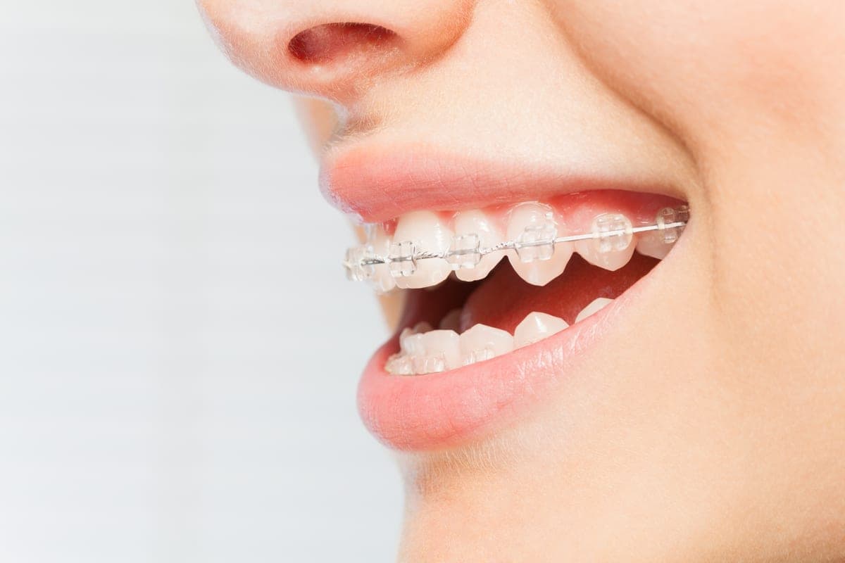 Ceramic Braces